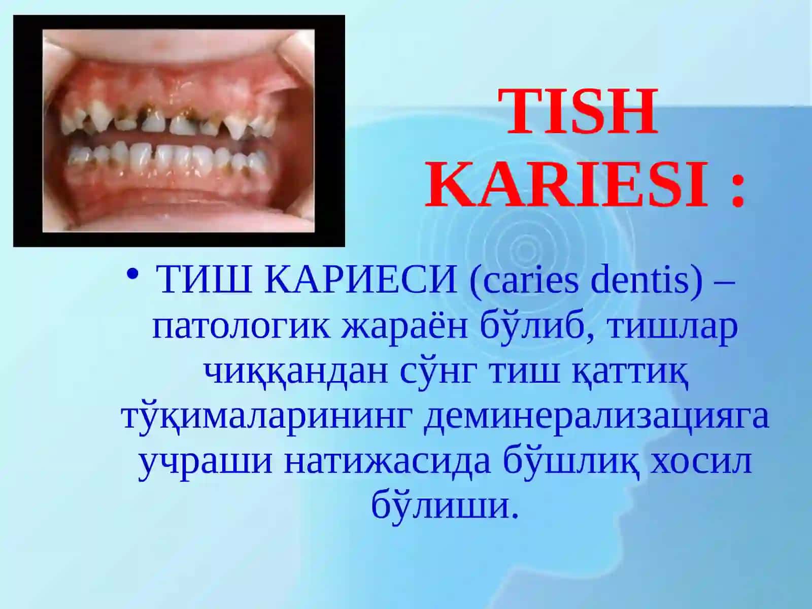 Tish kariesi 2