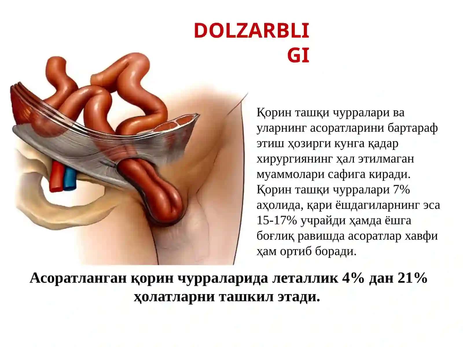 Qorin tashqi churralari va ularning asoratlari 2