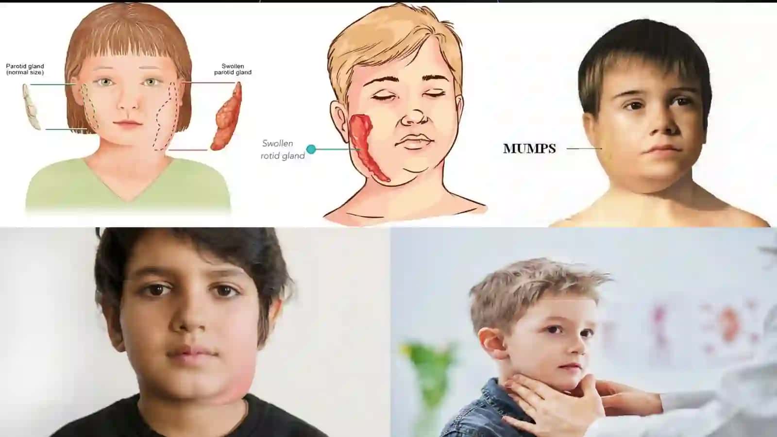 Mumps and Orchitis 2