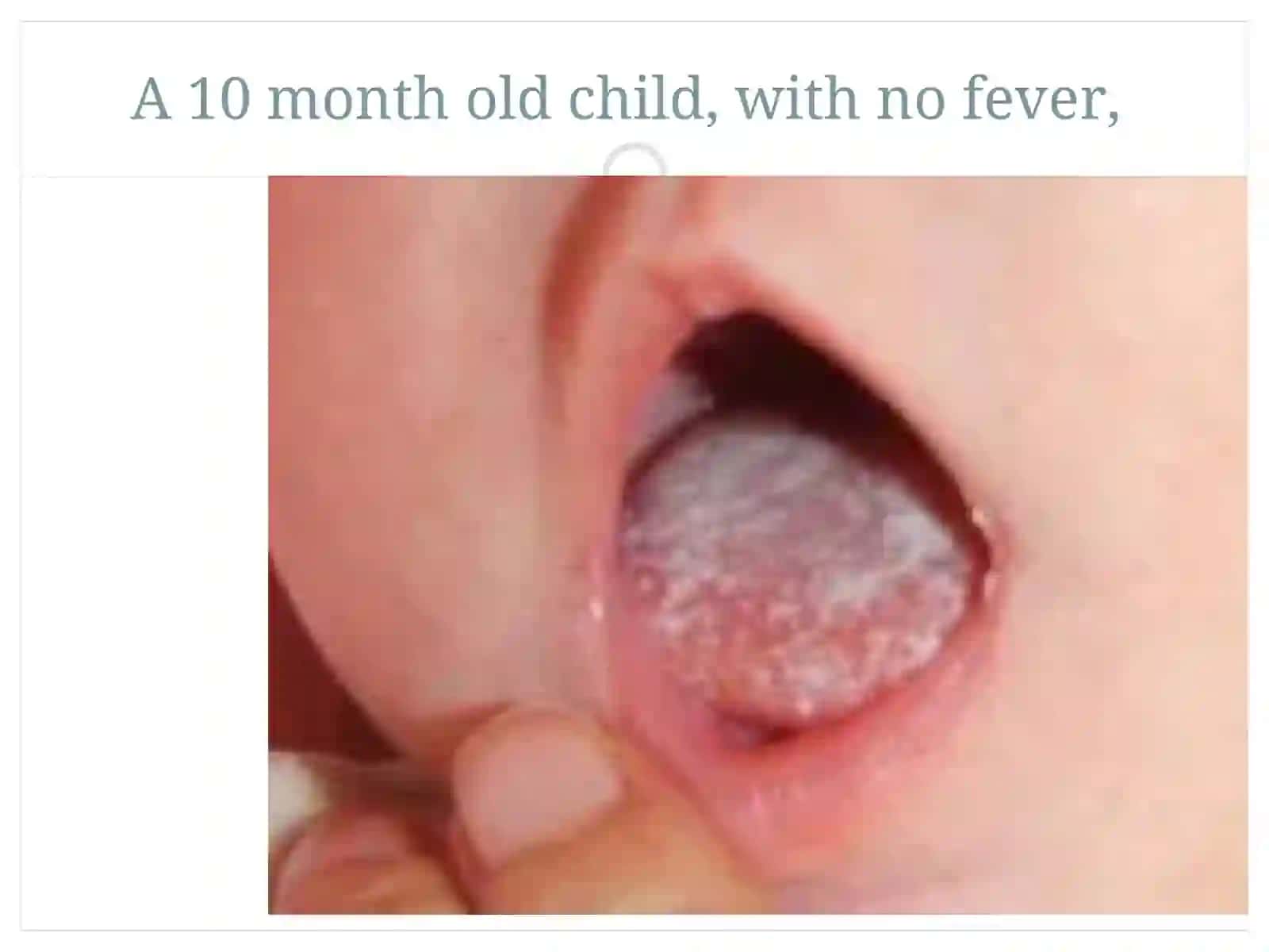 Oral Thrush-treatment 2