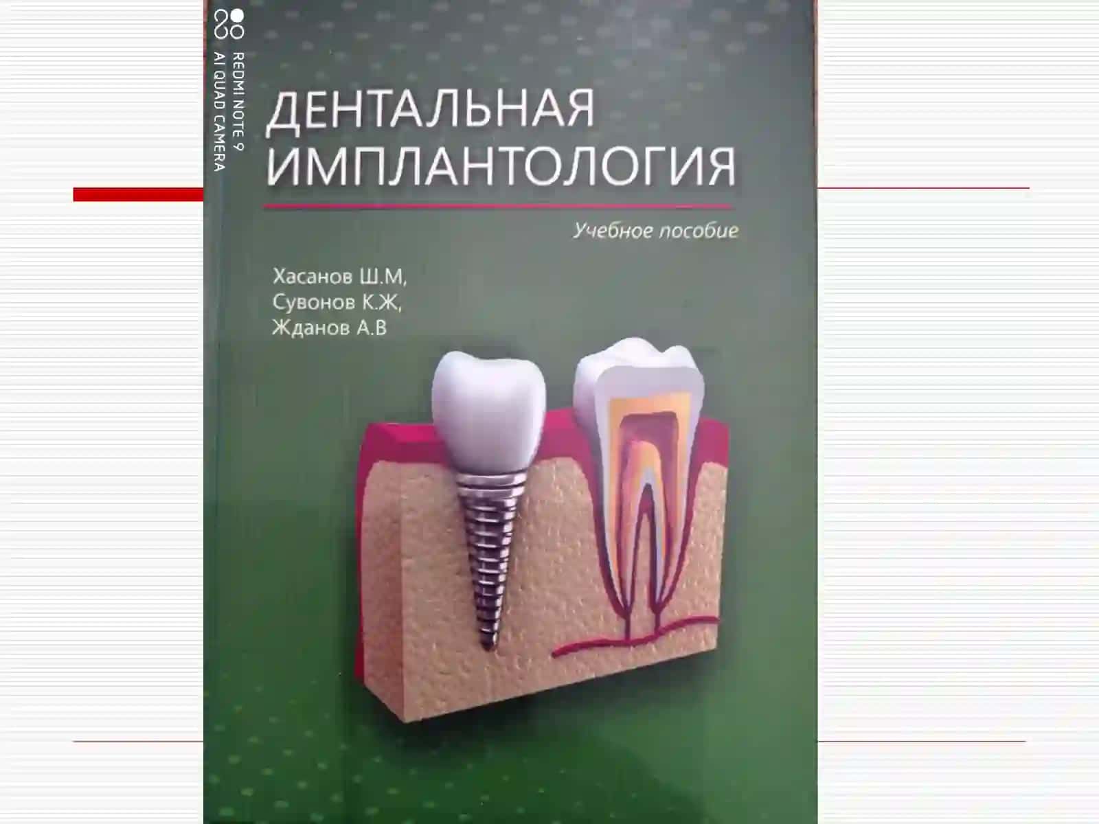 Дентал имплантация тарихи, ишлатадиган материаллар ва уларнинг таснифи. Дентал имплантацияга курсатма ва карши курсатмалар. Жаглардаги альвеоляр усигни атрофияси,таснифи. Жаглар альвеоляр усиги калинлиги ва баландлигини тиклаш уссуллари 2