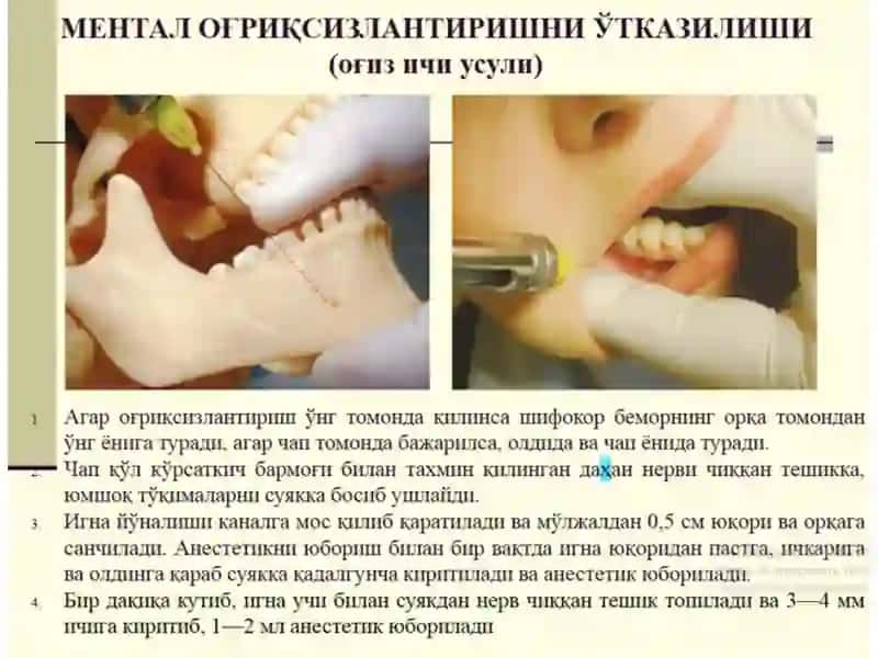Mandibulyar anesteziya 2