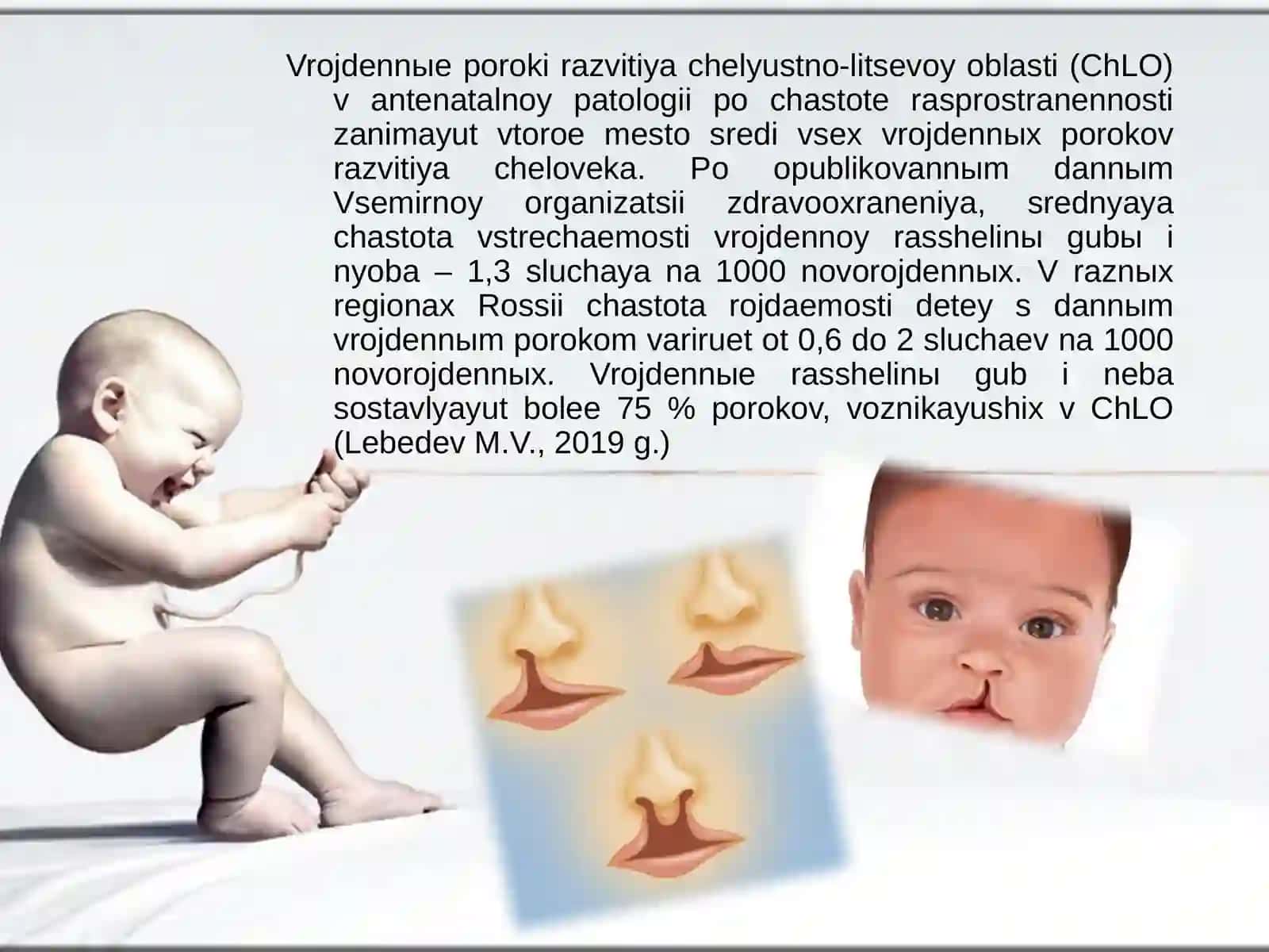 Tug'ma lab va tanglay yorig'i bo'lgan bolalarni parvarishlash 2