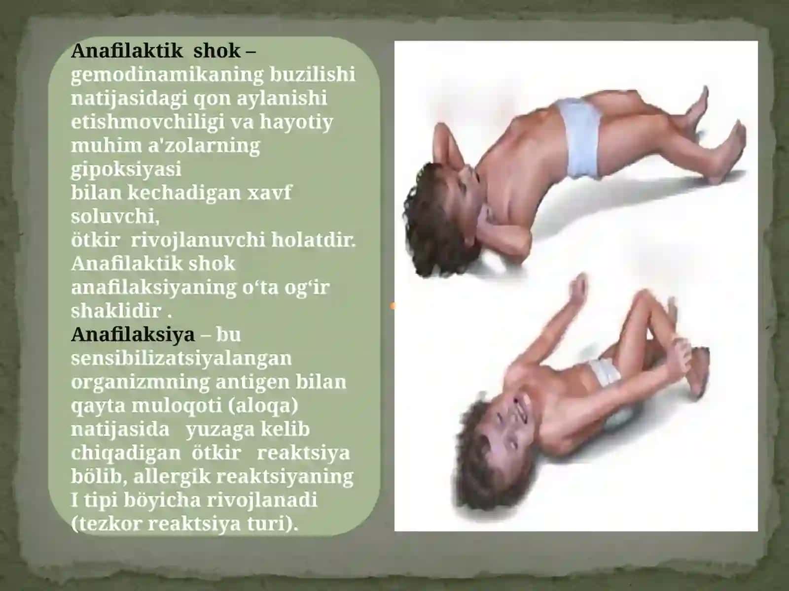 Anafilaktik shok 2