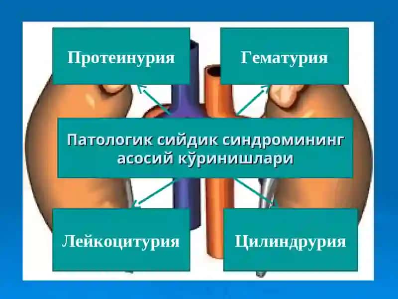 Сийдик чўкмасидаги ўзгаришлар билан кечадиган касалликларниқиёсийташҳислаш 2