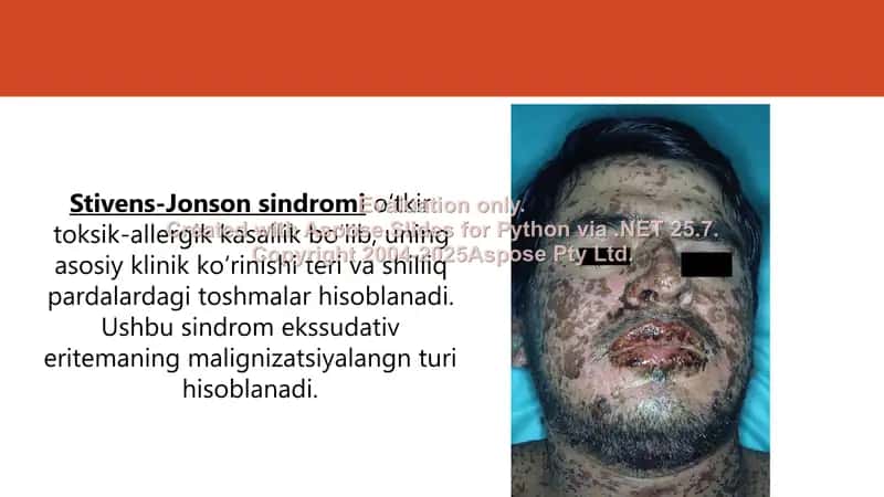 Stiven Jonson sindromi 2