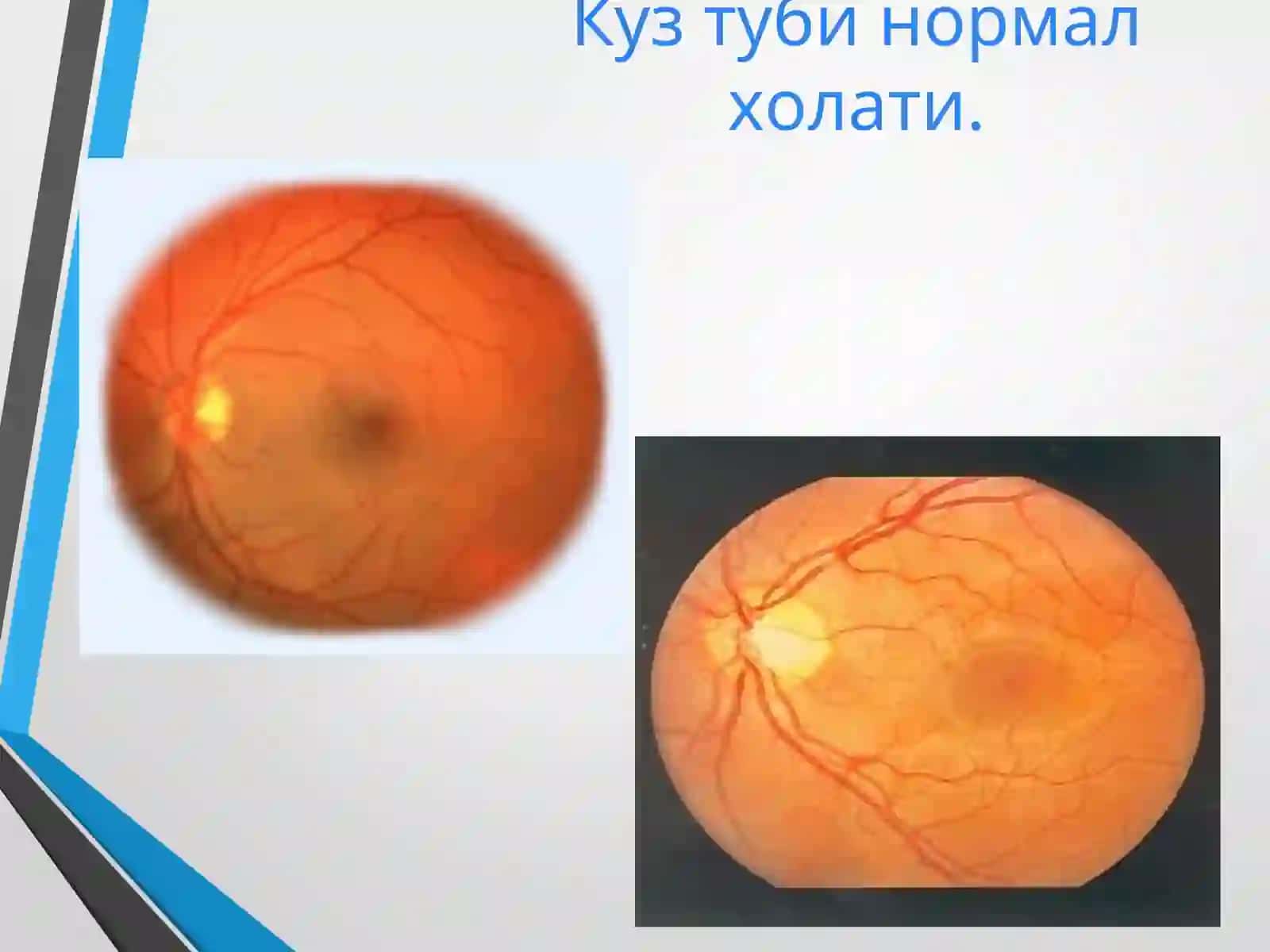 umumiy kasalliklarda kuzatiladigon ko'zdagi o'zgarishlr 2