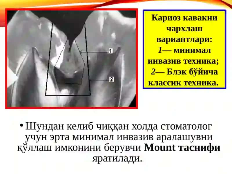 МИНИМАЛ ИНВАЗИВ ДАВОЛАШ (MIT — minimal intervention treatment) 2