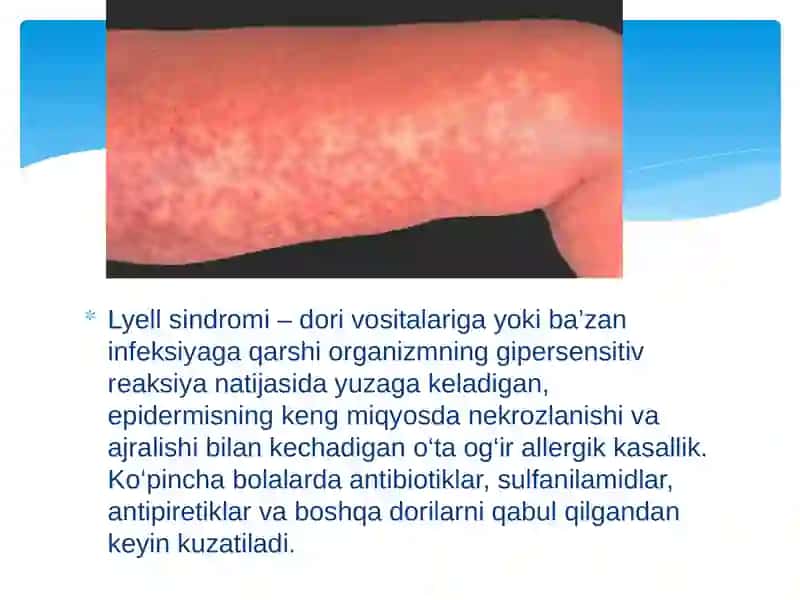 Lyell (Layella) sindromi – Toksik epidermal nekroliz 2