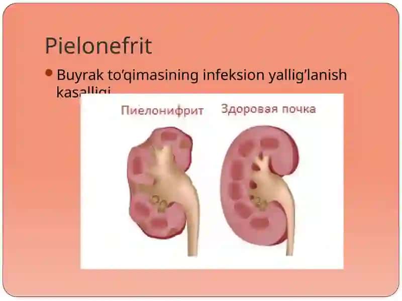 Pielonefrit 2