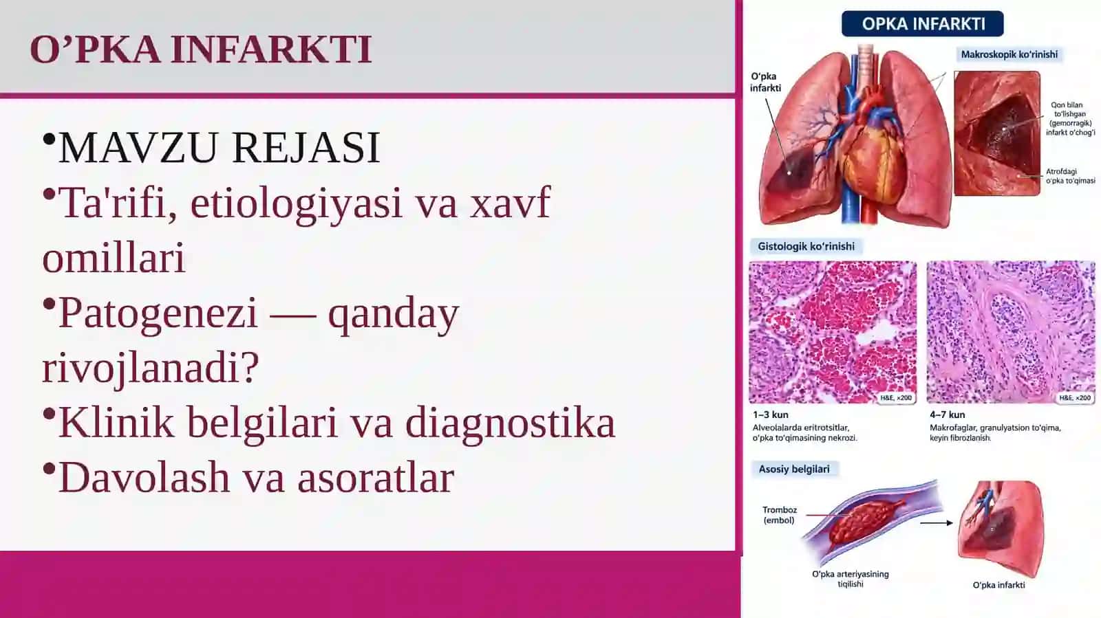 O'PKA INFARKI PREZENTATSIYA 2
