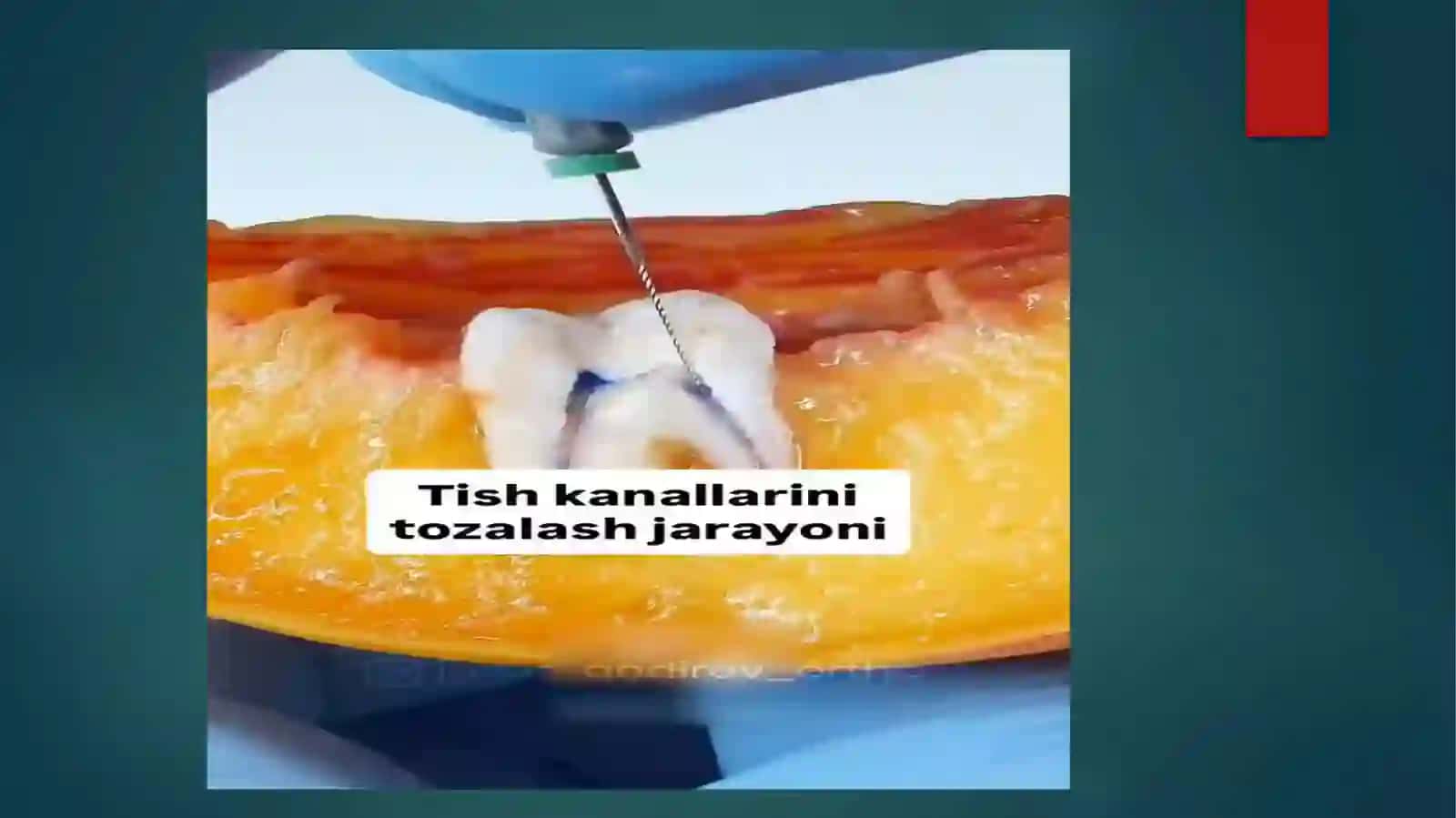 tish jarohati kilinkasi tashxislash davolash 2