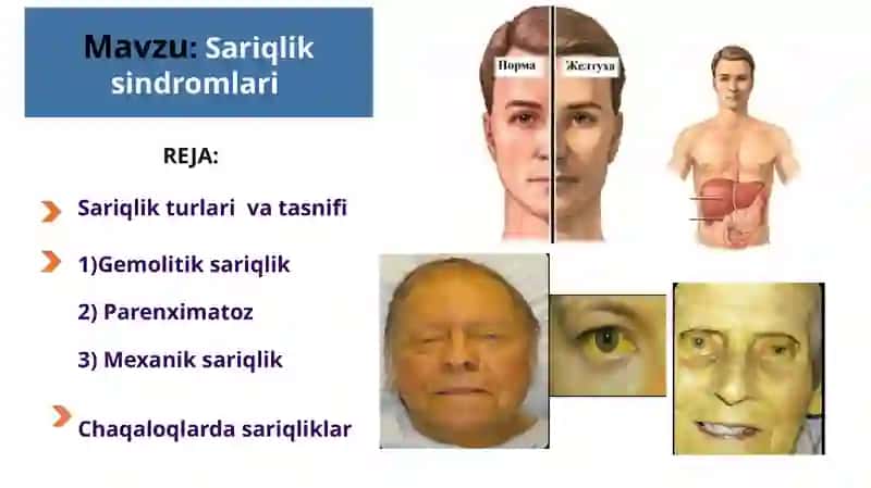 Sariqlik sindromlari 2
