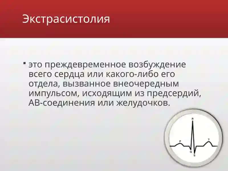 Экстрасистолии 2