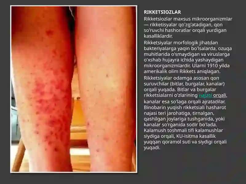RIKKETSIOZLAR: toshmali tif, Ku- isitmasi, qo'zg'atuvchilarning harakteristikasi va kasallikning labaratoriya diagnostikasi 2