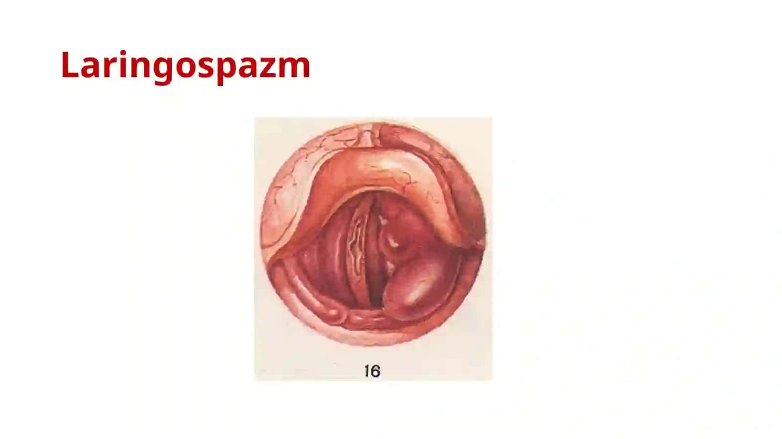 Laringospazm.Tez yordam algoritmi 2
