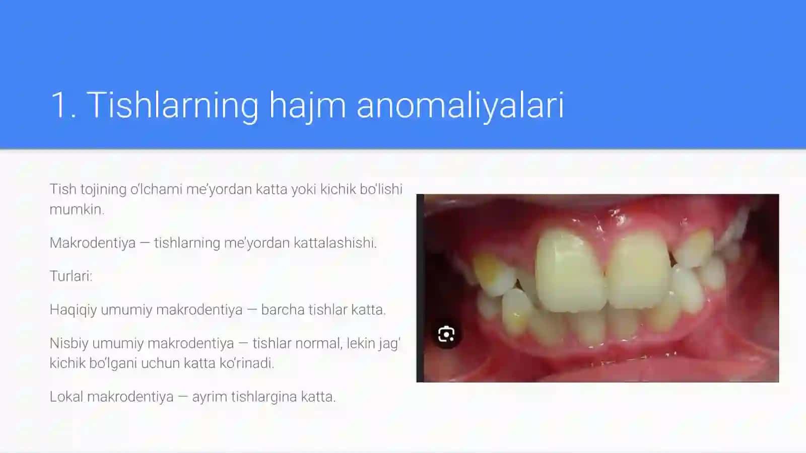 Tishlarni xajm va miqdor anomaliyalari 2