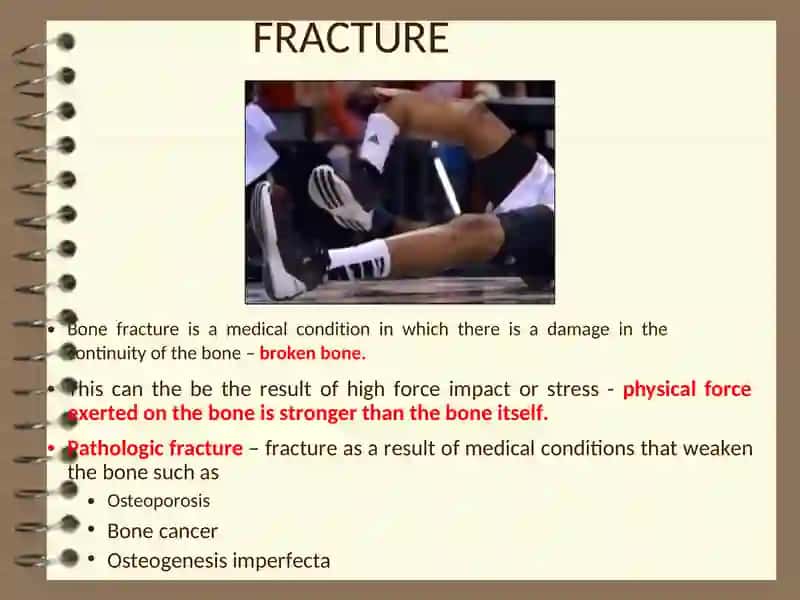 FRACTURES 2