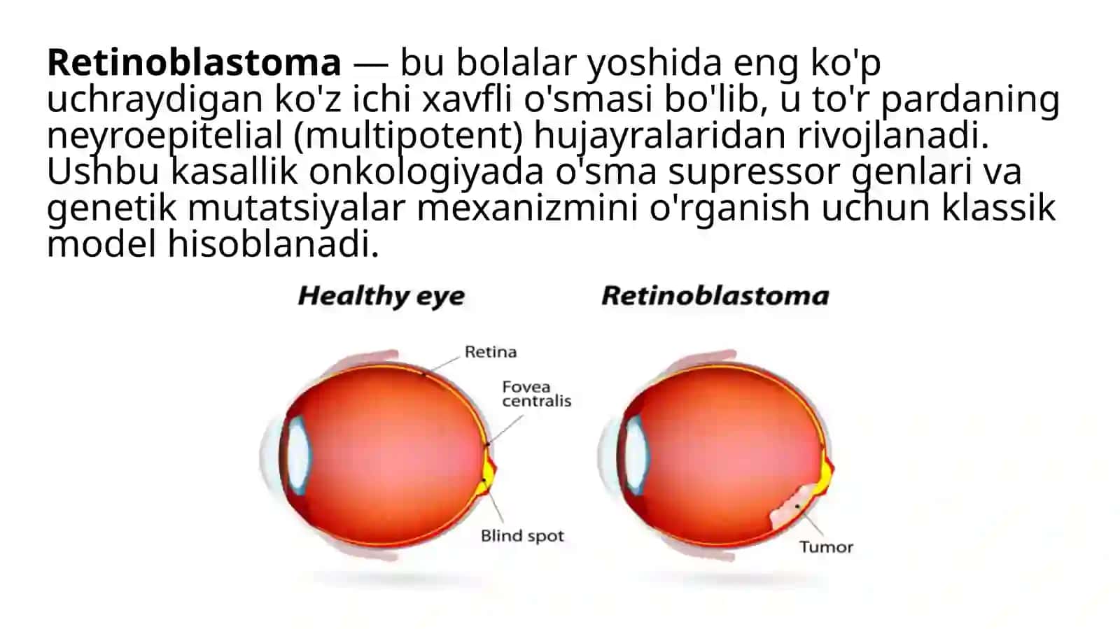 Retinoblastoma 2