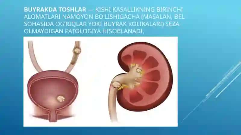 Buyraklarda Urat Toshsini Davolash 2
