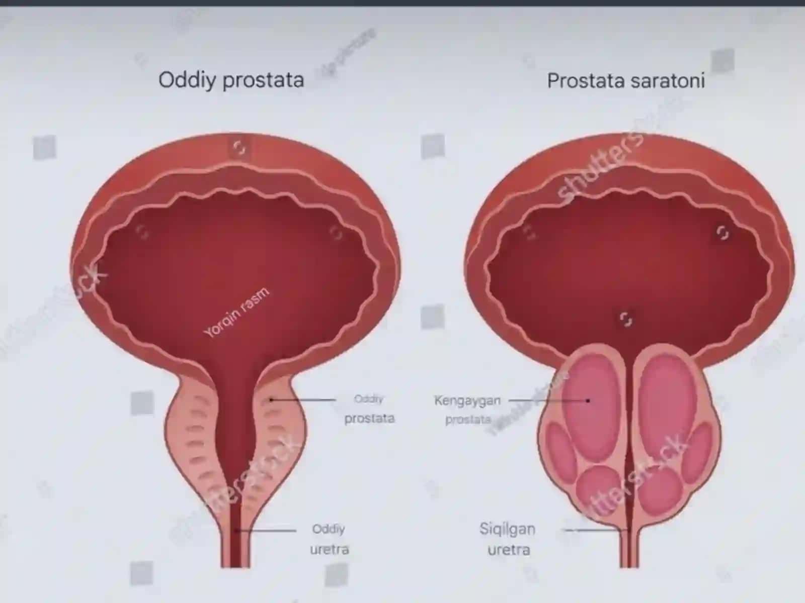Prostata bezi o’smalari 2