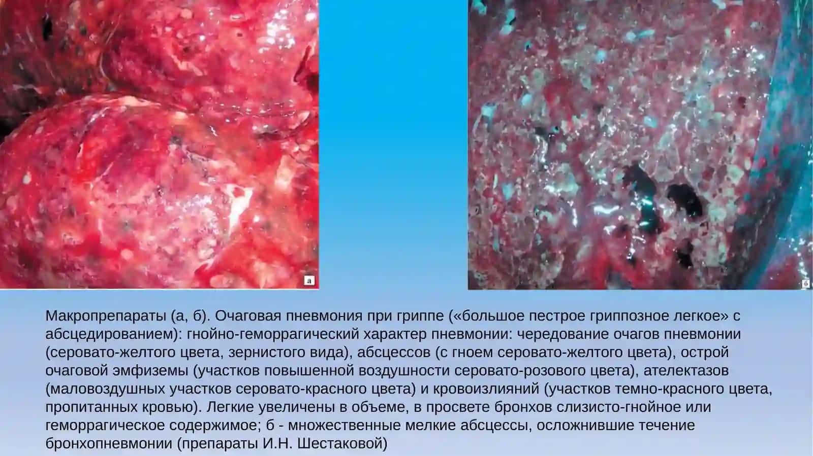 Макропрепараты (а, б). Очаговая пневмония при гриппе («большое пестрое гриппозное легкое» сабсцедированием) 2