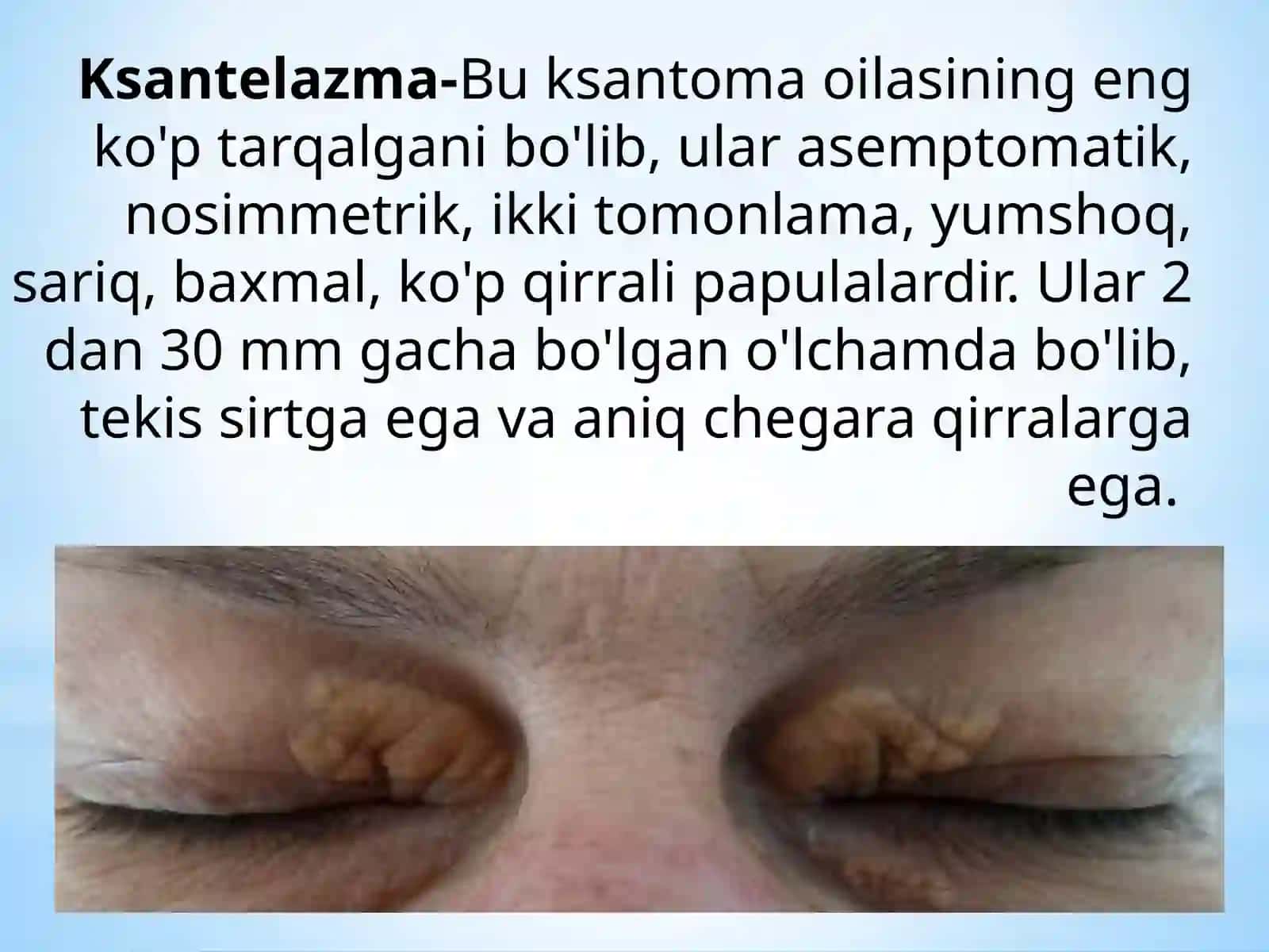 Ksantelazma.Lipoma.Gigroma 2