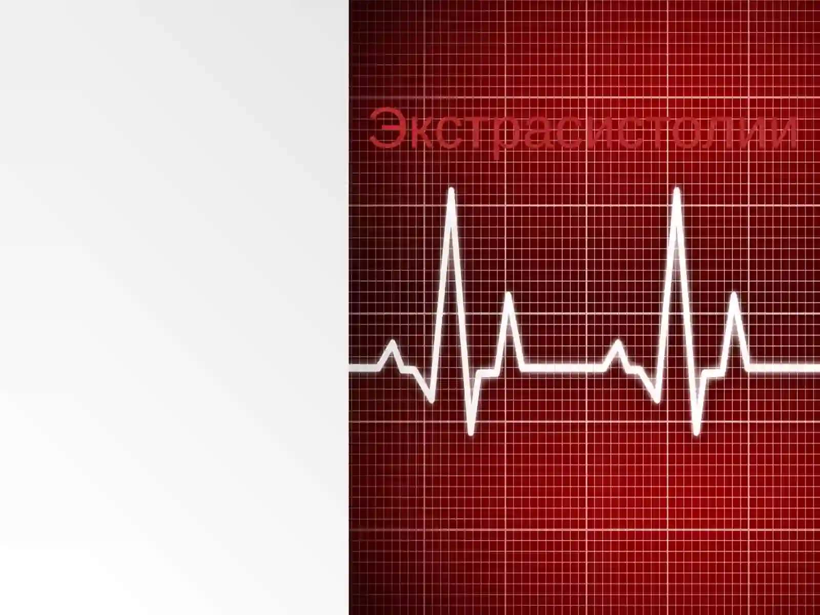 Экстрасистолия 2