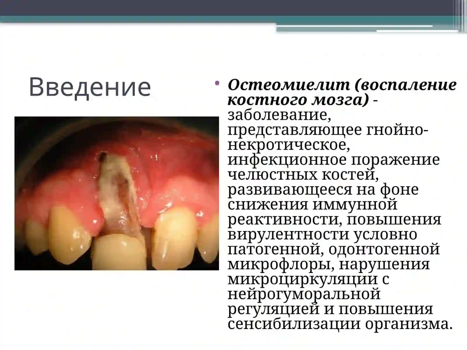 Одонтогенный остеомиелит челюсти 2