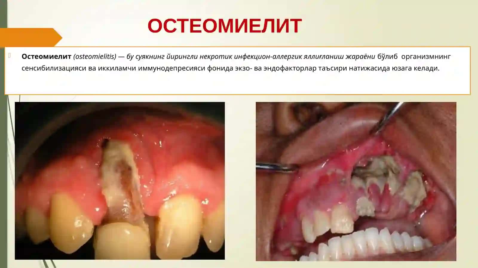 O‘tkir vasurun kalio dentogen osteomiyelit 2