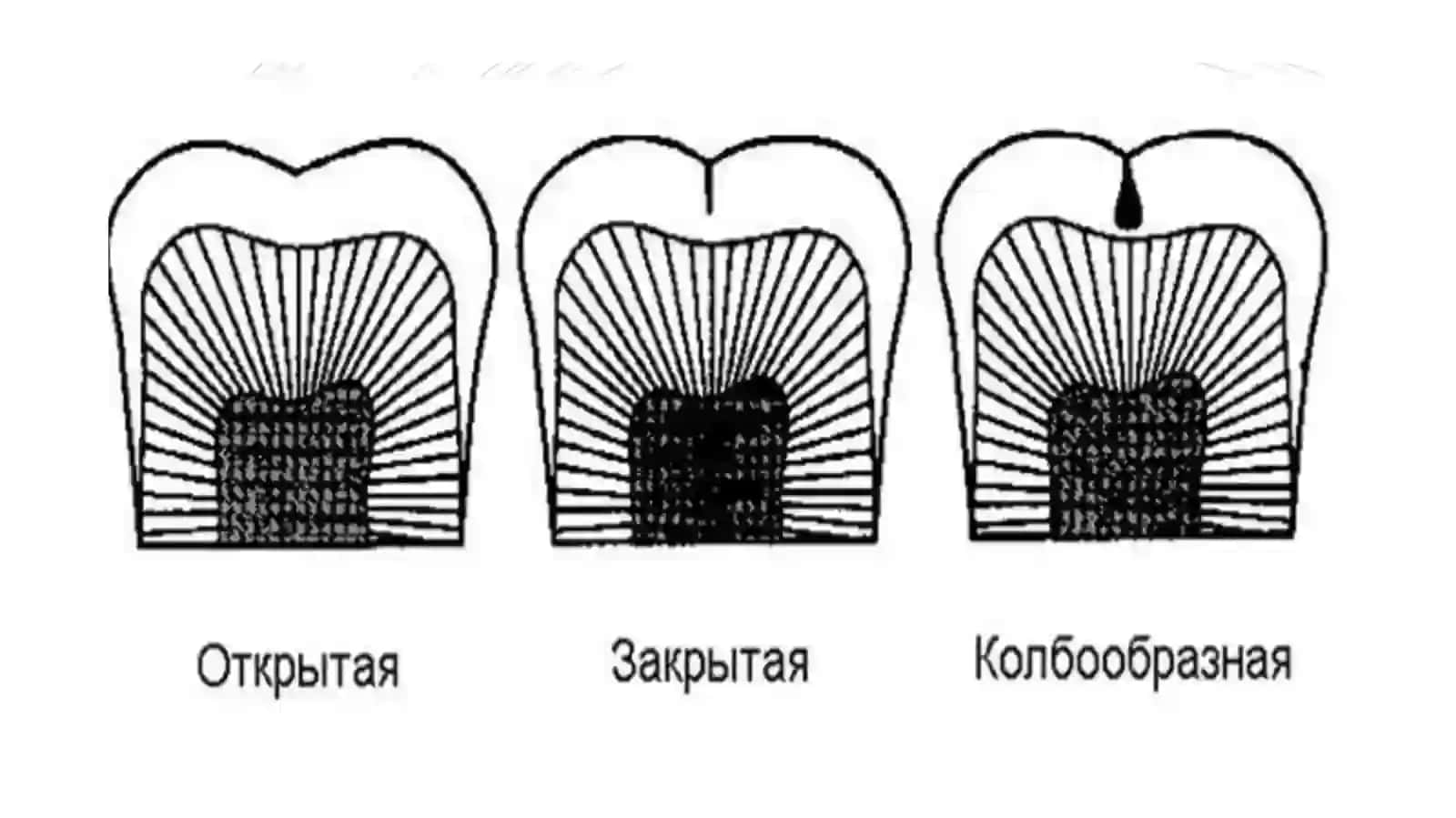 Герметизация фиссур 2