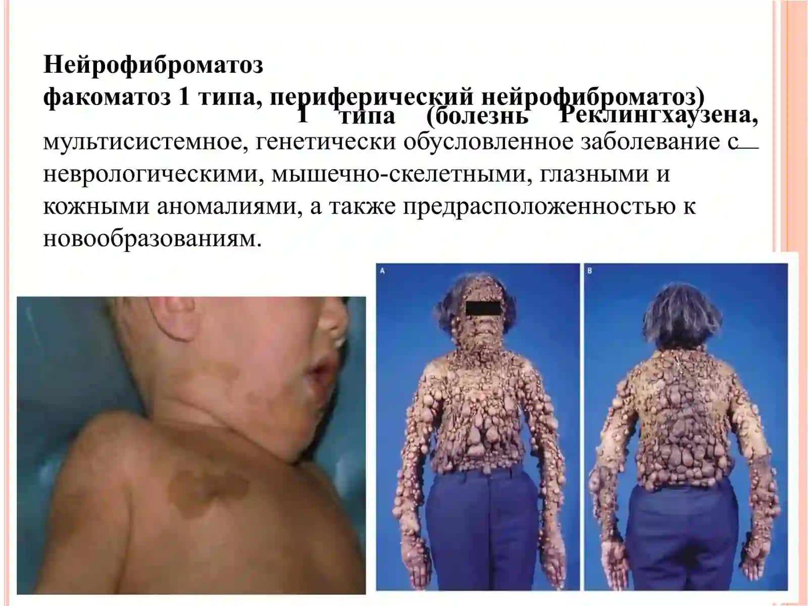 Нейрофиброматоз 1го типа 2