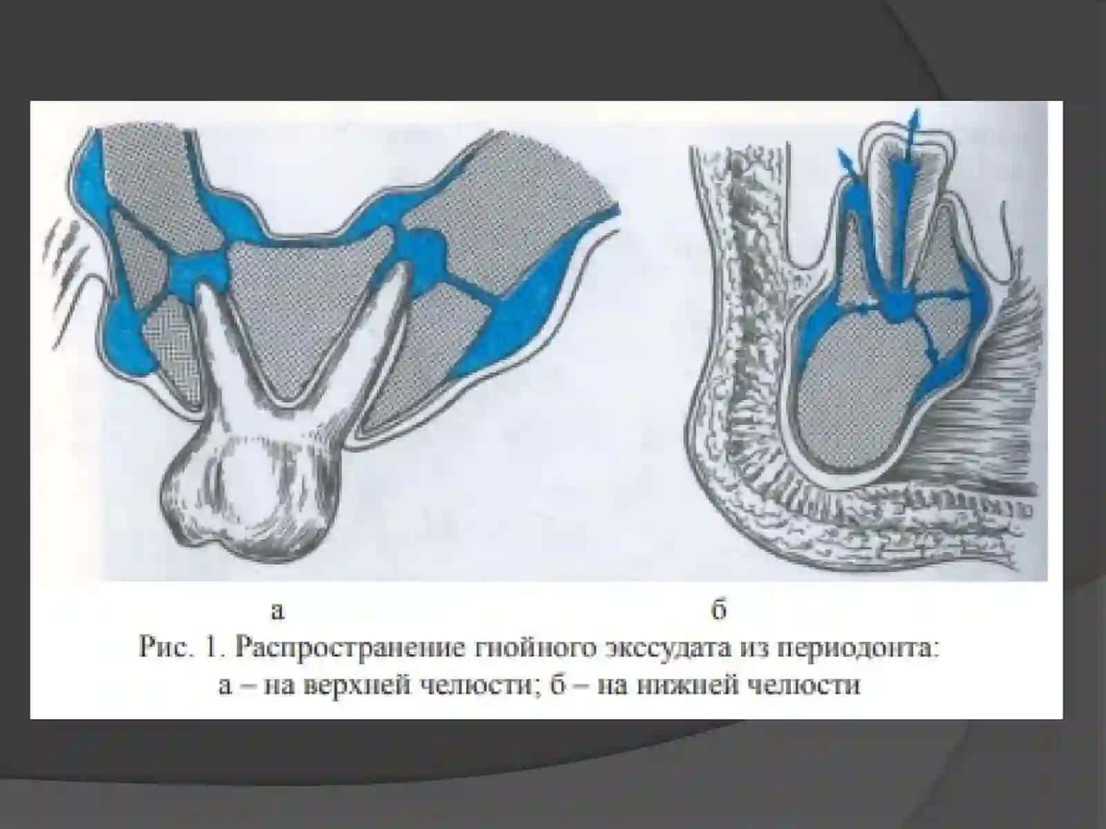 Periodontitlarni tekshirish natijalariga ko‘ra tashxislash va xirurgik davolash usullariga ko‘rsatma va qarshi ko‘rsatmalarni aniqlash. Periodontitlarni xirurgik davolashda tish saqlovchi operatsiyalar 2