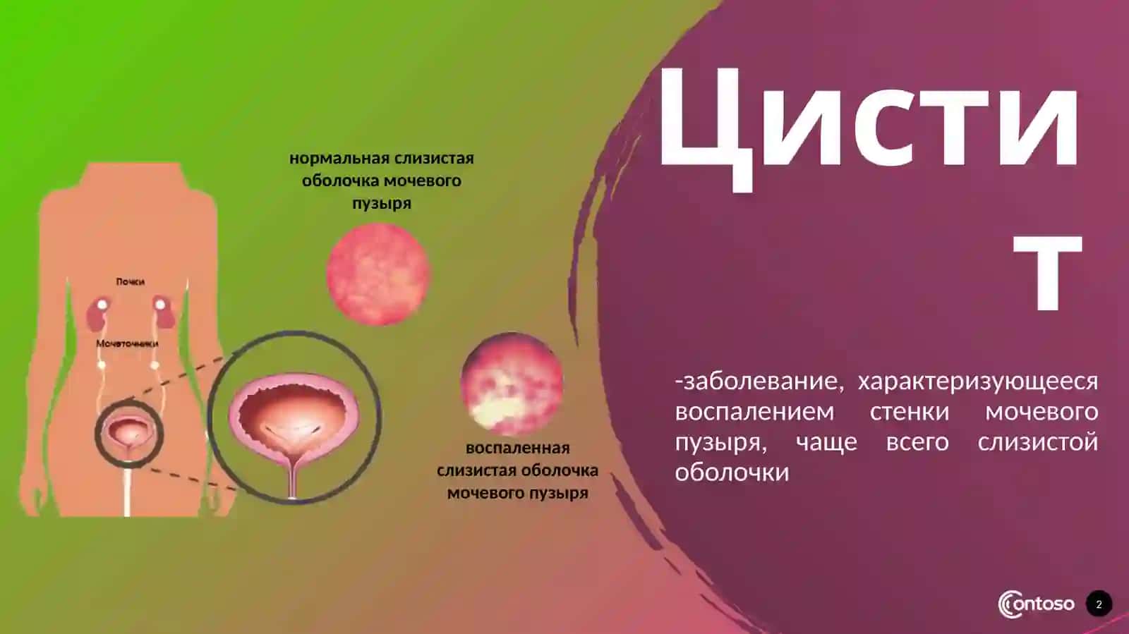 Цистит уретрит 2