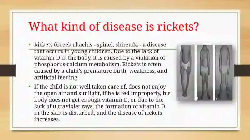 Rickets 2