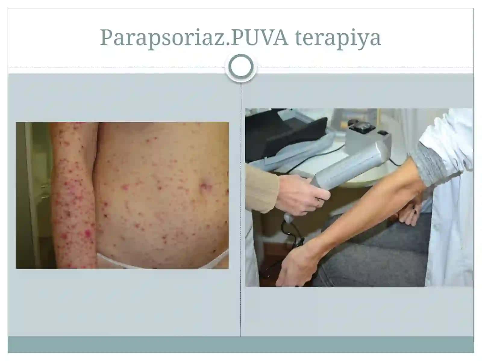 Parapsoriaz.PUVAterapiya 2