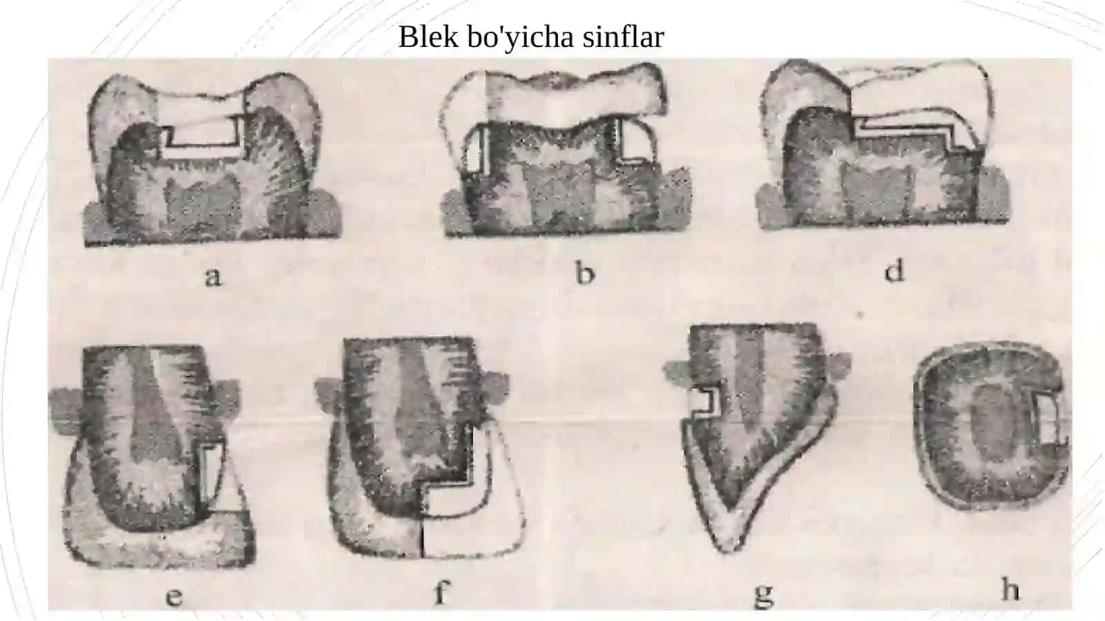 Tish qattiq to'qimalarini charxlash bosqichlari va tamoyullari 2