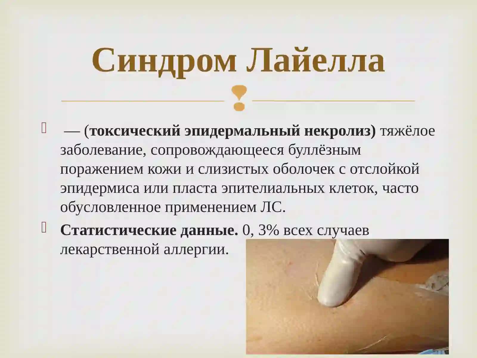 СИНДРОМ ЛАЙЕЛЛА 2