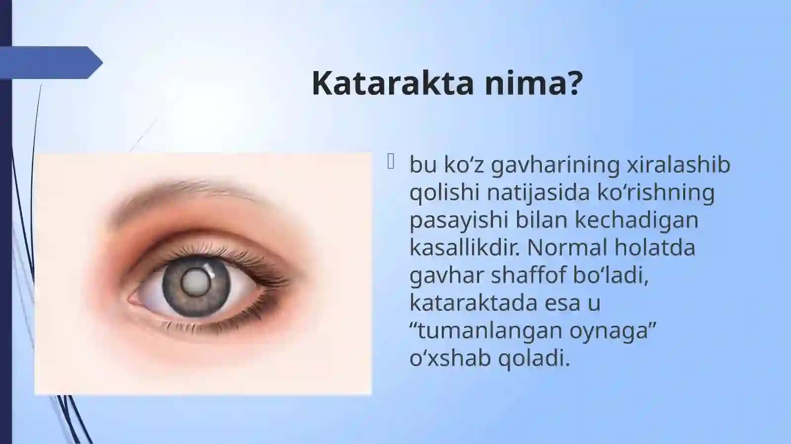 katarakta 2
