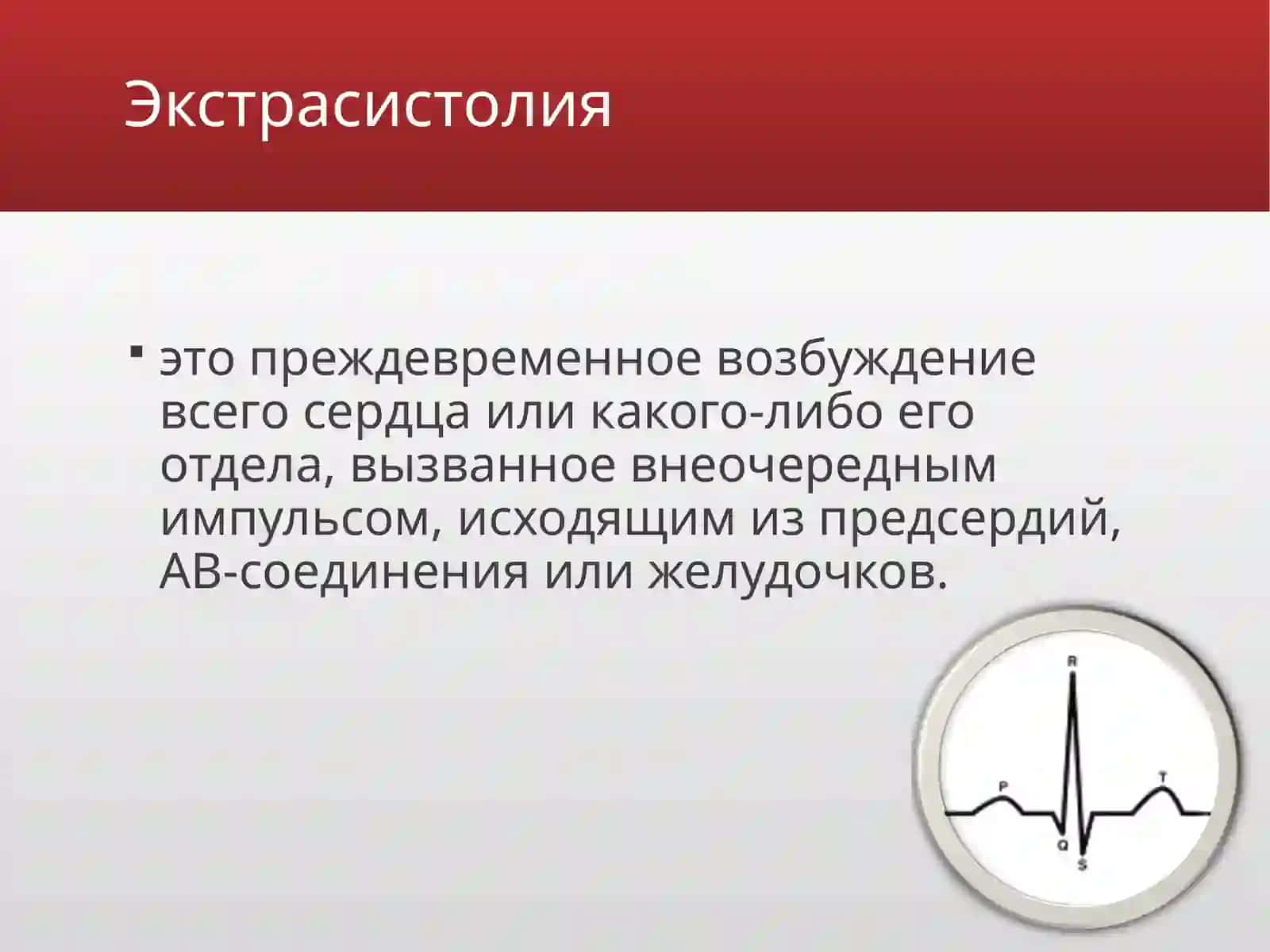 Экстрасистолии 2