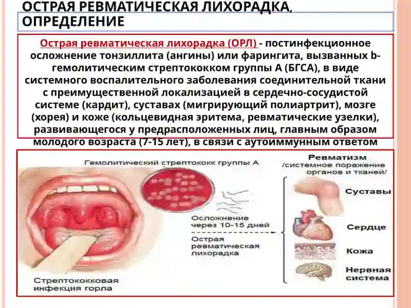 ОСТРАЯ РЕВМАТИЧЕСКАЯ ЛИХОРАДКА, ОПРЕДЕЛЕНИЕ 2