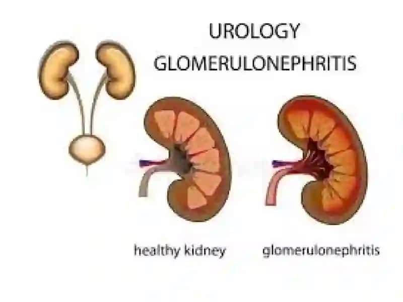 Glomerulonefrit 2