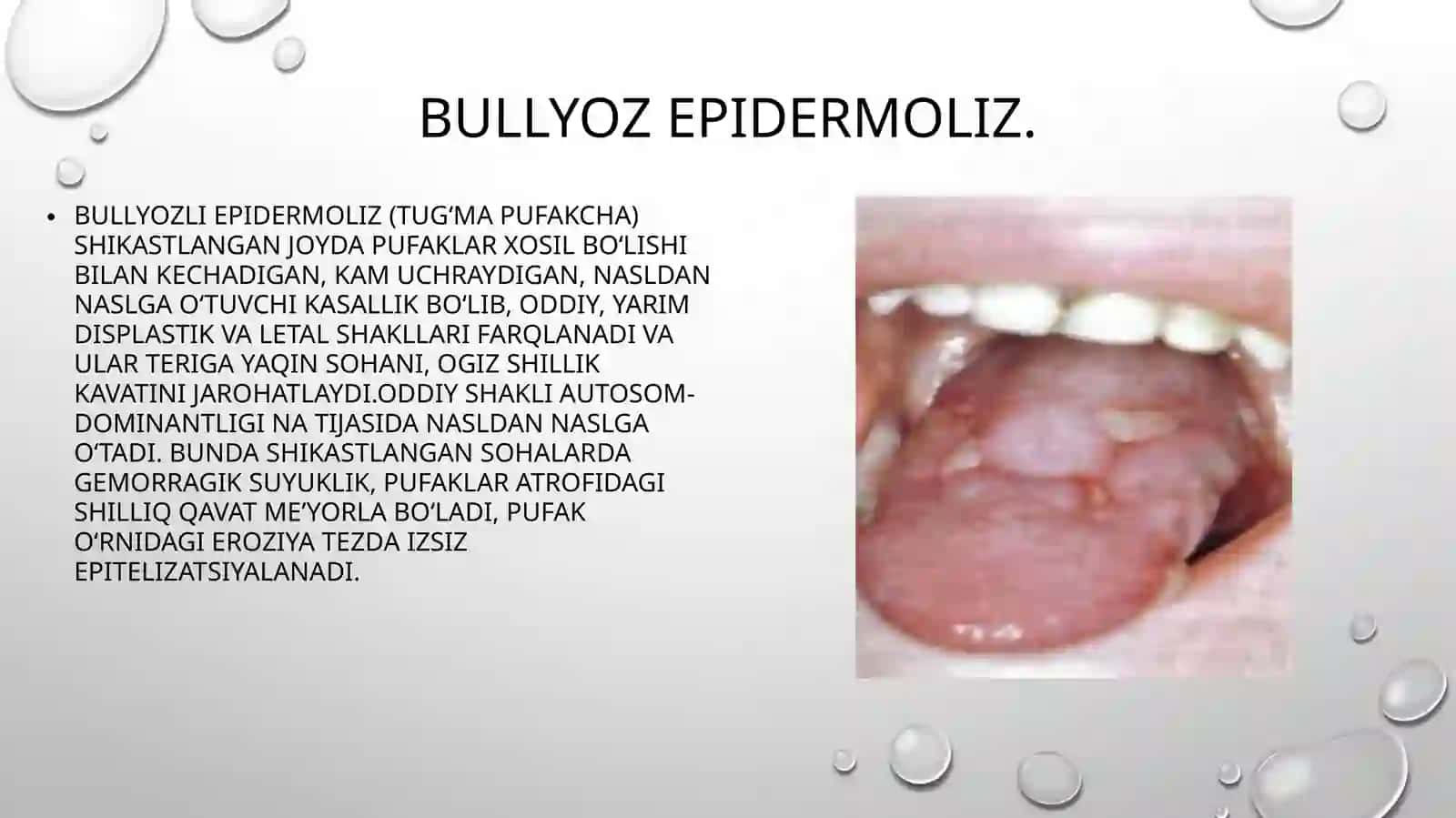 Bullyozepidermoliz 2