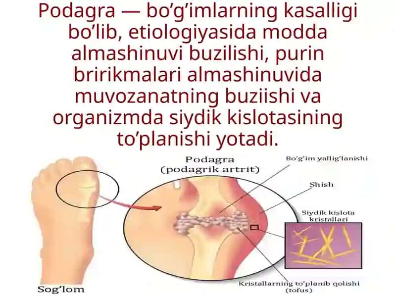 Giperurikemiya va podagra 2