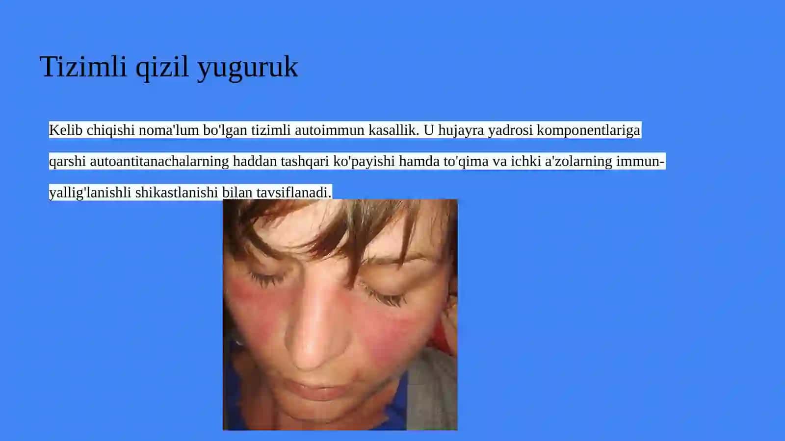 Tizimli qizil yugurik kasalligi (1-variant) 2