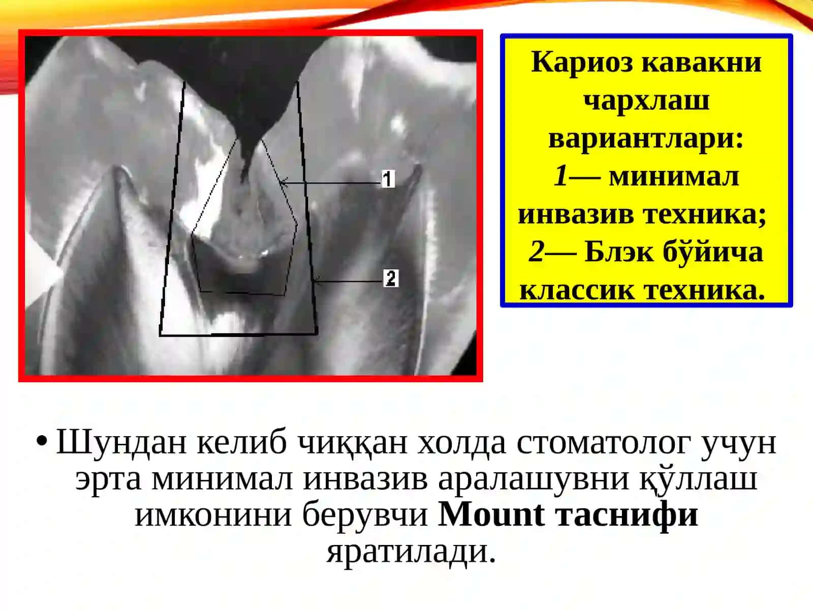 МИНИМАЛ ИНВАЗИВ ДАВОЛАШ(MIT—minimal interventiontreatment) 2