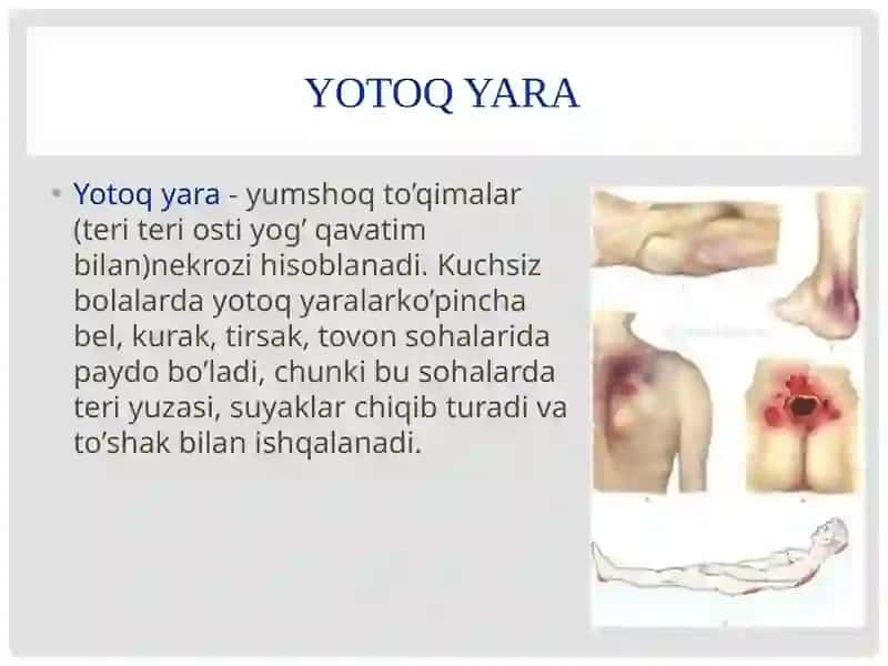 Yotoq yara 2
