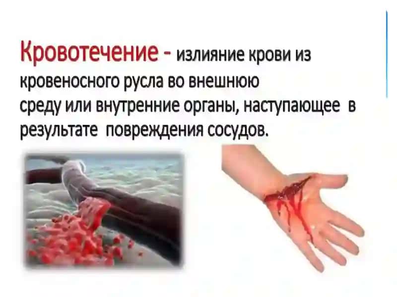КРОВОТЕЧЕНИЕ,ВИДЫ КРОВОТЕЧЕНИЯ, ОКАЗАНИЕ ПЕРВОЙ ПОМОЩИ ПРИ КРОВОТЕЧЕНИИ 2