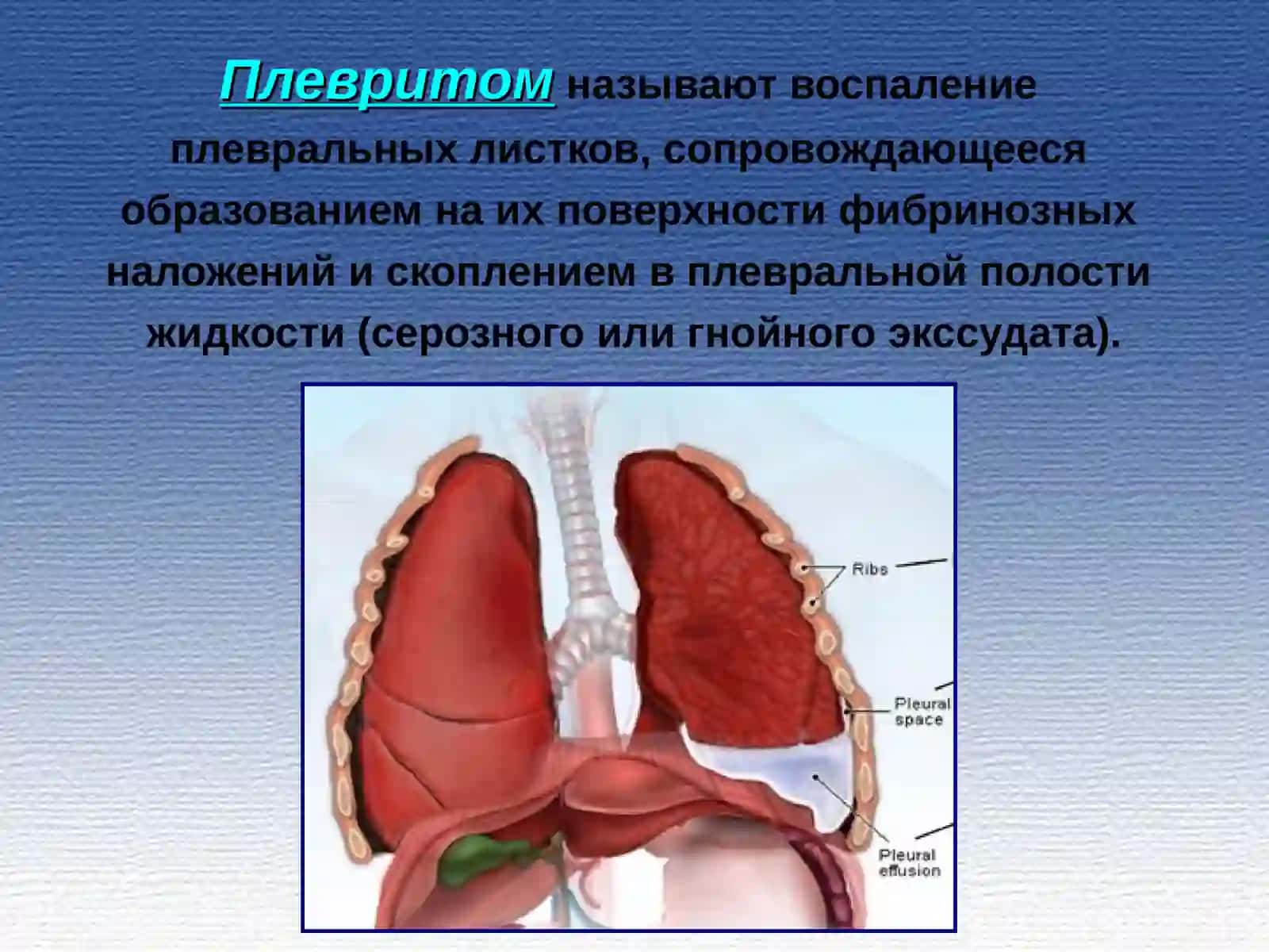 Плеврит. Классификация 2