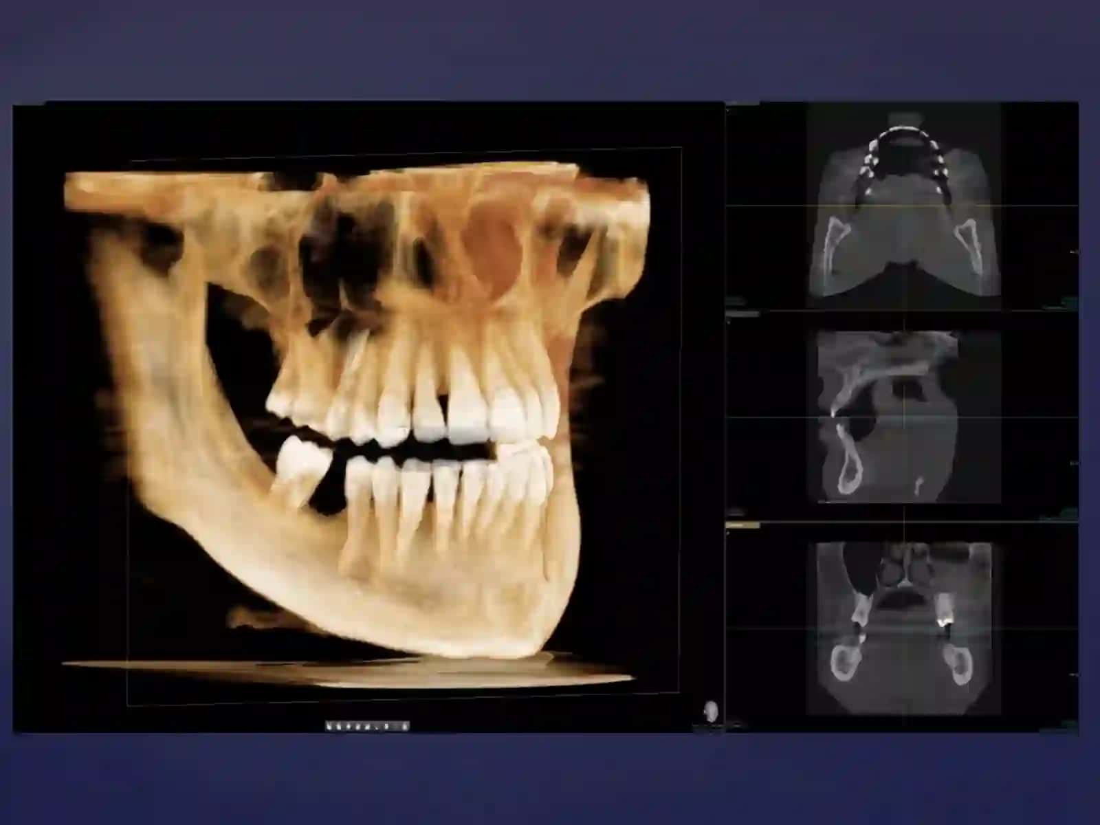 KLIKTasosida dental implantatsiyani 3D rejallash 2